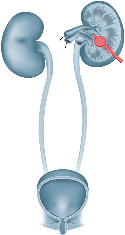 nierenkatheter|Perkutane Nephrostomie